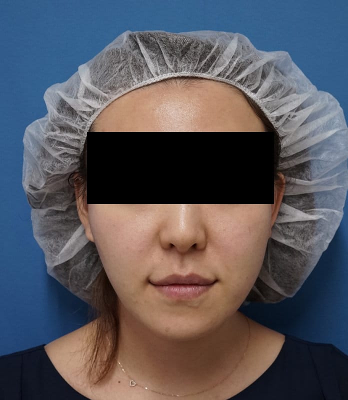 糸で簡単若返り|プレミアムショッピングスレッド 処置直後のAfterの写真