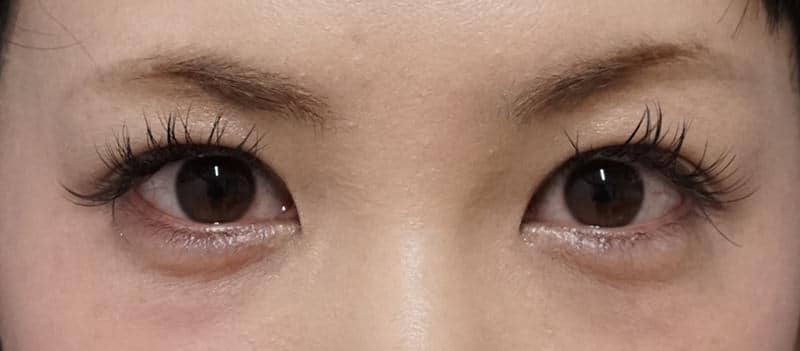 切らない眼瞼下垂　半年後のAfter写真