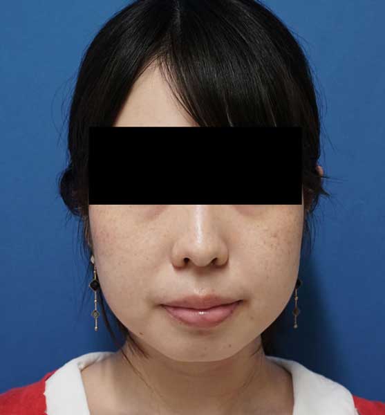 ＢＮＬＳ10cc（ホホ・フェイスライン）1週間後のBefore写真