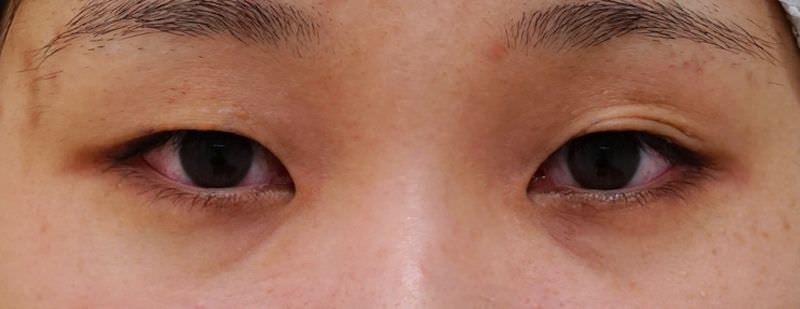 もとびアイプラチナム 1か月後のBefore写真