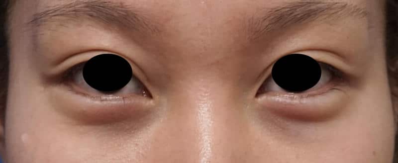 切らないたれ目 1週間後のBefore写真