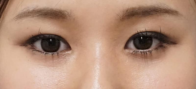 涙袋形成(ヒアルロン酸) 処置直後のBefore写真