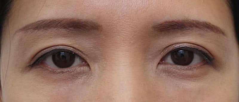 自然な目の上の若返り|眉下切開 1ヶ月後のAfterの写真