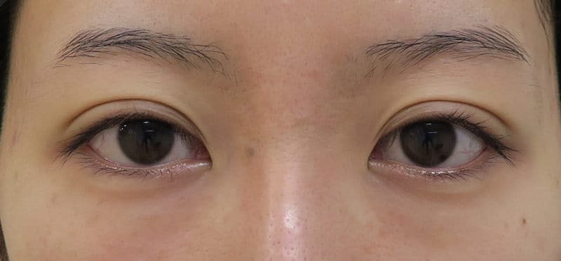 下眼瞼下制（たれ目形成術）、目頭切開、もとびアイプラチナム　1週間後のBefore写真