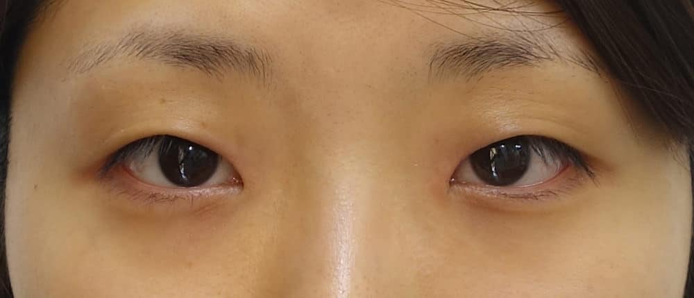 エステティックアイの1か月後のBefore写真
