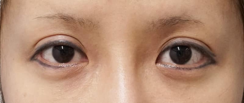 切らない眼瞼下垂、切らないタレ目　1週間後のBefore写真