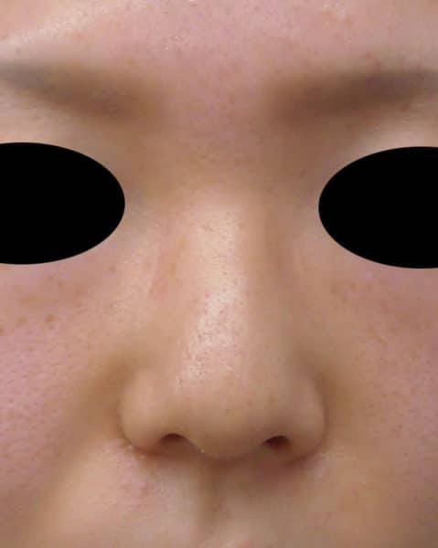 鼻尖形成３Ｄ法、Ｉ型プロテーゼ　3ヶ月後のBefore写真