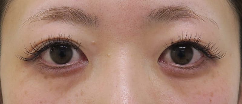 腫れにくい！もとびアイプラチナム　手術直後のBefore写真