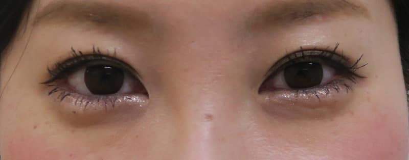 他院抜糸(8点)、もとびアイプラチナム 1週間後のAfterの写真