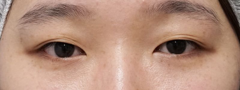 もとびアイプラチナム　１ヶ月後のBefore写真