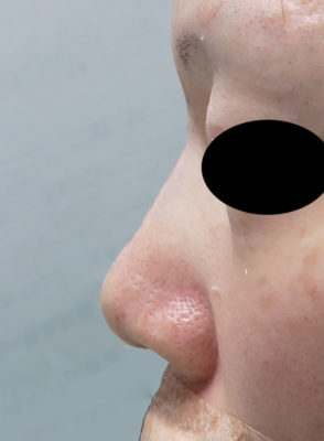 高めのお鼻プロテーゼ　１週間後のBefore写真