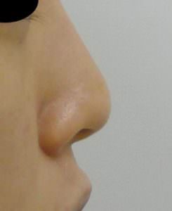 鼻尖形成 軟骨移植 術前右側面