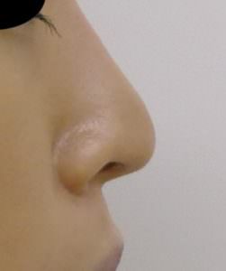 鼻尖形成 軟骨移植 術後左側面