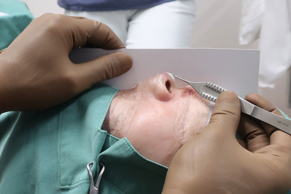 鼻施術の際のシュミレーション型紙