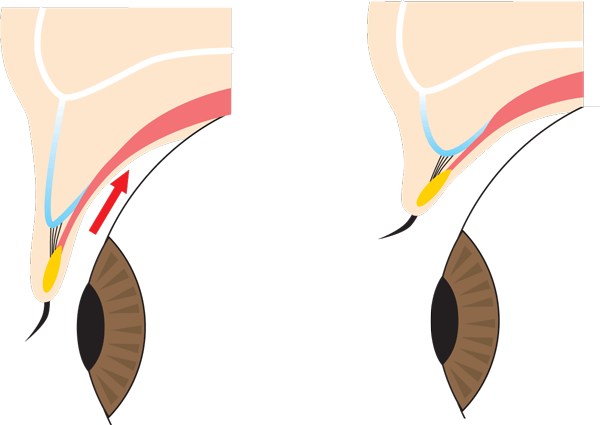 上眼瞼の断面図。目を閉じたとき、目を開いた時