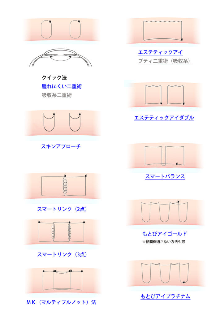 もとび美容外科の埋没法の種類