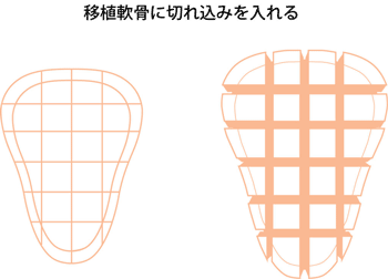 移植軟骨に切れ込みを入れる