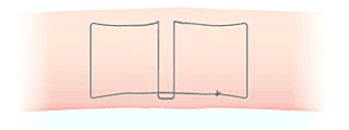 二重埋没法（スマートバランス）かけ方の図