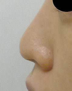 鼻尖形成 軟骨移植 術前左側面