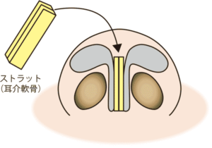 鼻尖軟骨移植（ストラット）解説