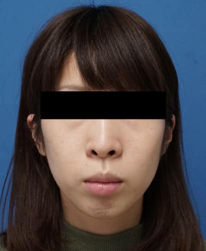 クレヴィエル(アゴ) 1週間後のBefore写真