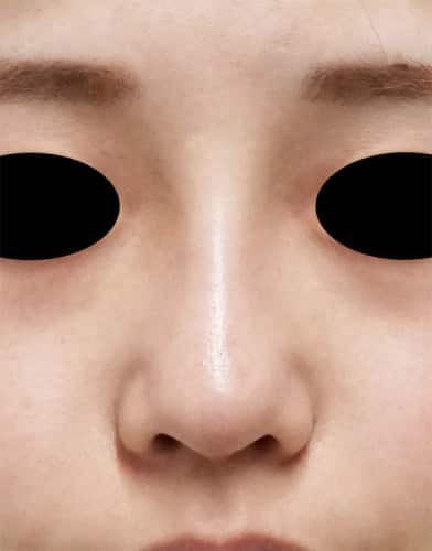 Ｉ型鼻プロテーゼ　１ヶ月後のAfterの写真