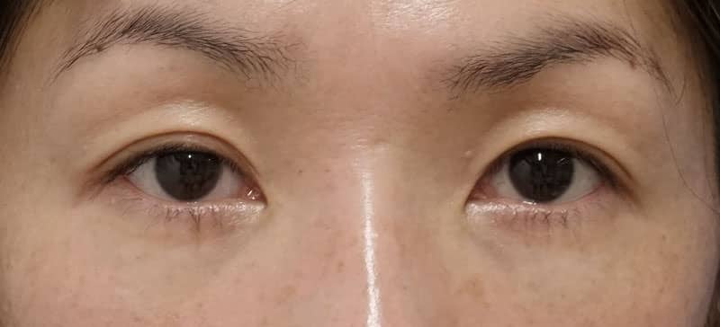 切らない眼瞼下垂プレミアム　3ヶ月後のBefore写真