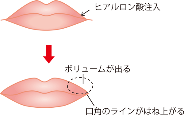 口角を上げるヒアルロン酸
