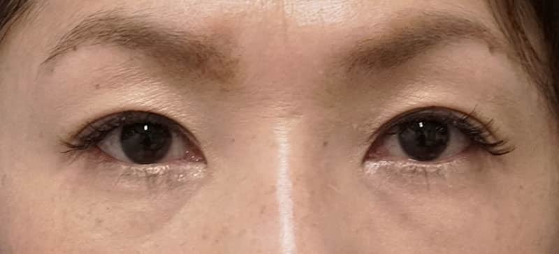 切らない眼瞼下垂プレミアム　3ヶ月後のAfterの写真