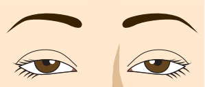 眼瞼下垂の目元