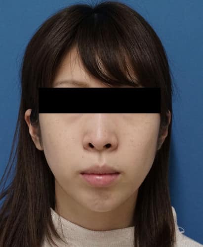 クレヴィエル(アゴ) 1週間後のAfterの写真