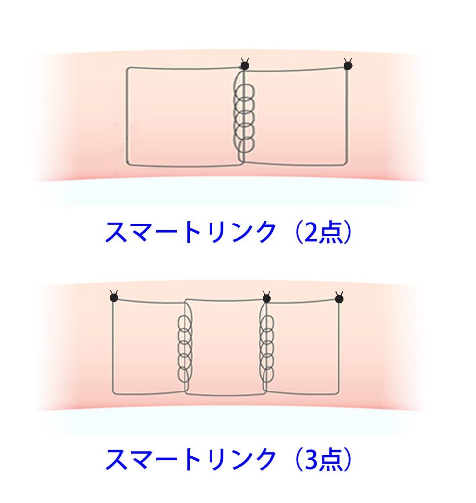 二重埋没法（スマートリンク）のかけ方