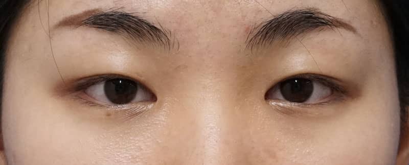 切らない眼瞼下垂プレミアム　１ヵ月後のBefore写真