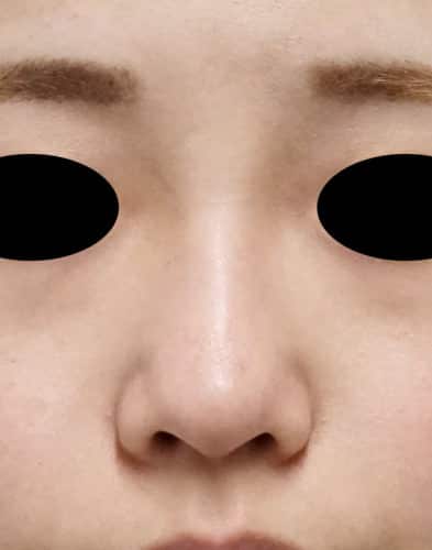 Ｉ型鼻プロテーゼ　１ヶ月後のBefore写真