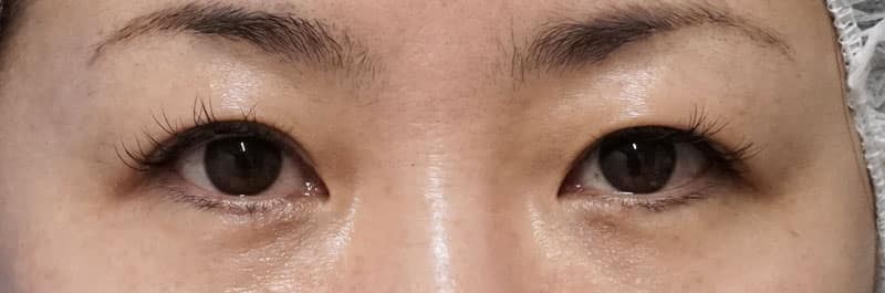 もとびアイプラチナム 手術直後のBefore写真