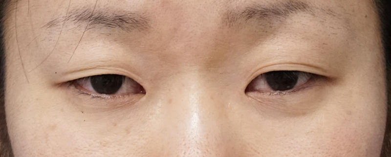 下眼瞼下制　１週間後、全切開・眼瞼下垂・目頭切開　半年後のBefore写真