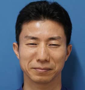 院長の眉間ボトックス　１週間後　プチ整形