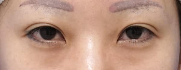 目尻切開、目頭切開(リドレープ法) 手術直後のBefore写真