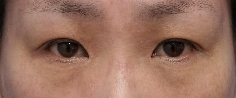 下眼瞼下制、目の下の脂肪とり　１ヶ月後のBefore写真