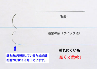 腫れにくい糸-二重埋没法