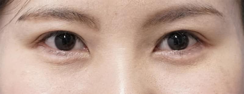 涙袋形成(ヒアルロン酸) 処置直後のAfterの写真