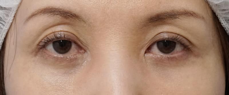 切らない眼瞼下垂プレミアム　１週間後のBefore写真