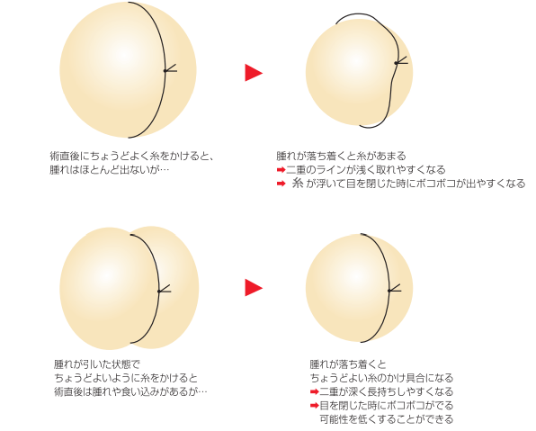 腫れがある時と腫れが引いた時の糸のイメージ