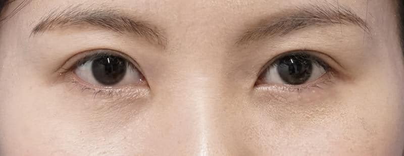 涙袋形成(ヒアルロン酸) 処置直後のBefore写真