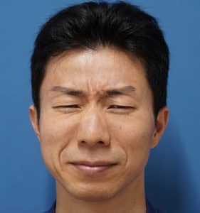 院長の眉間ボトックス　施術前　プチ整形