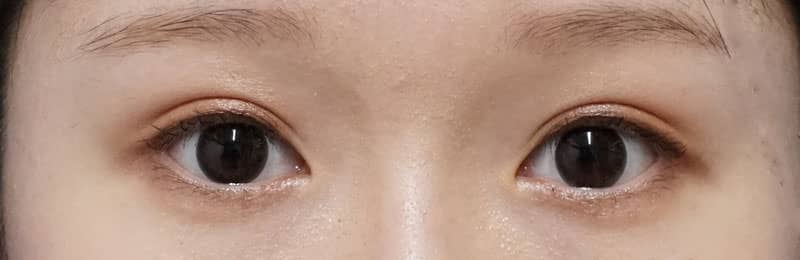 もとびアイプラチナム　１ヶ月後のAfterの写真