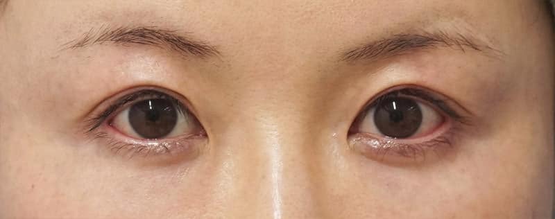 切らない眼瞼下垂 　手術直後のAfterの写真