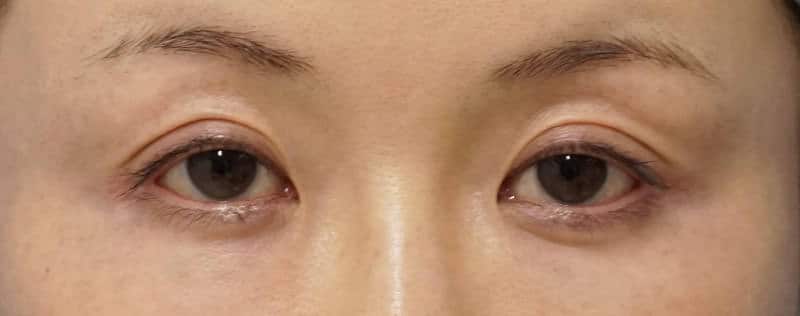 切らない眼瞼下垂 　手術直後のBefore写真