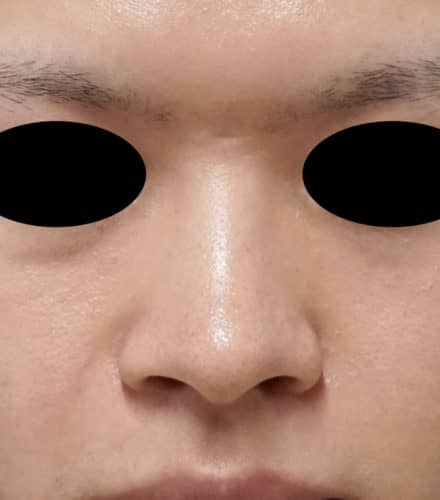 鼻尖縮小＋軟骨移植＋ストラット、鼻翼縮小（内＋外）　３ヶ月後　正面のBefore写真
