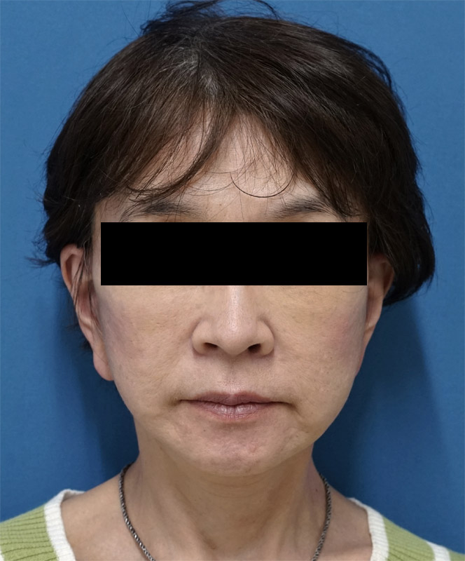 ミントリフトミニ 1週間後のAfterの写真